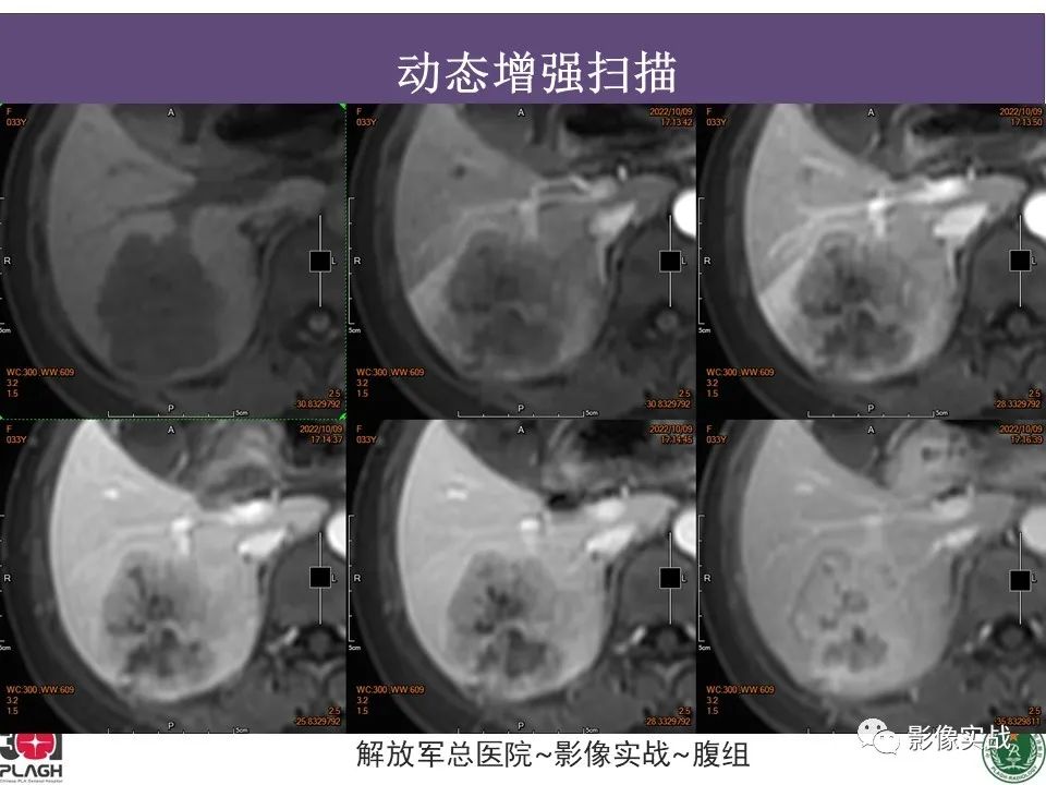 影像PPT - 【病例】肝内胆管细胞癌1例MR影像-14