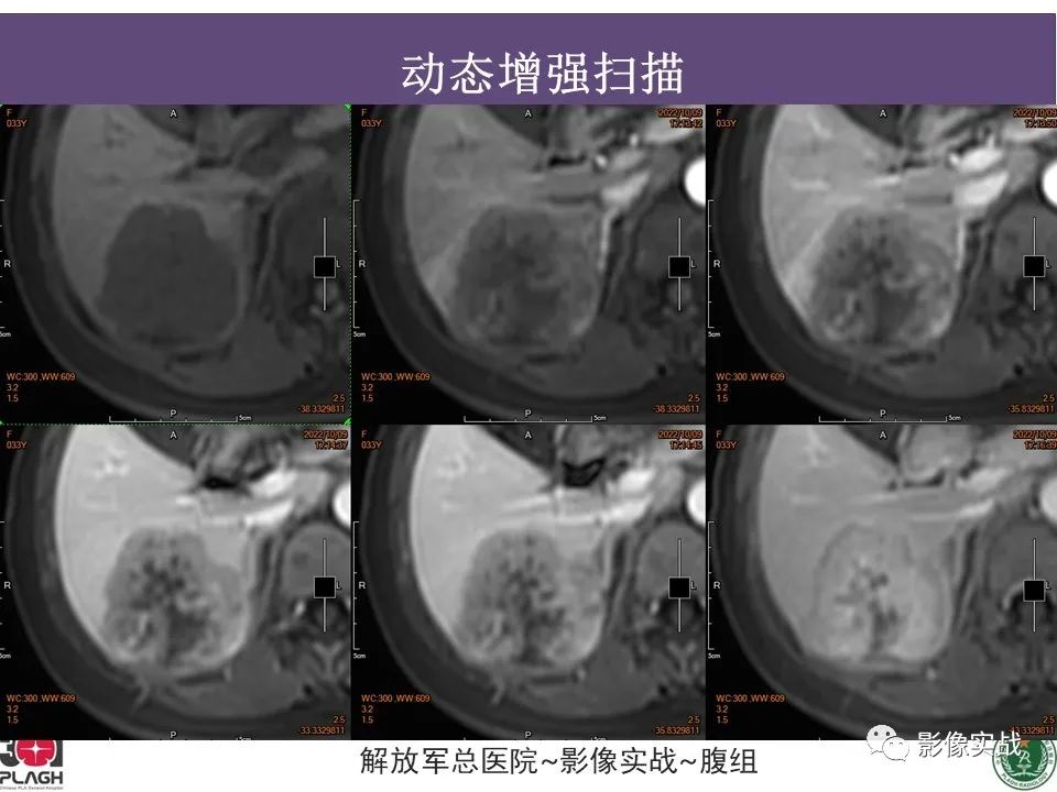 影像PPT - 【病例】肝内胆管细胞癌1例MR影像-15