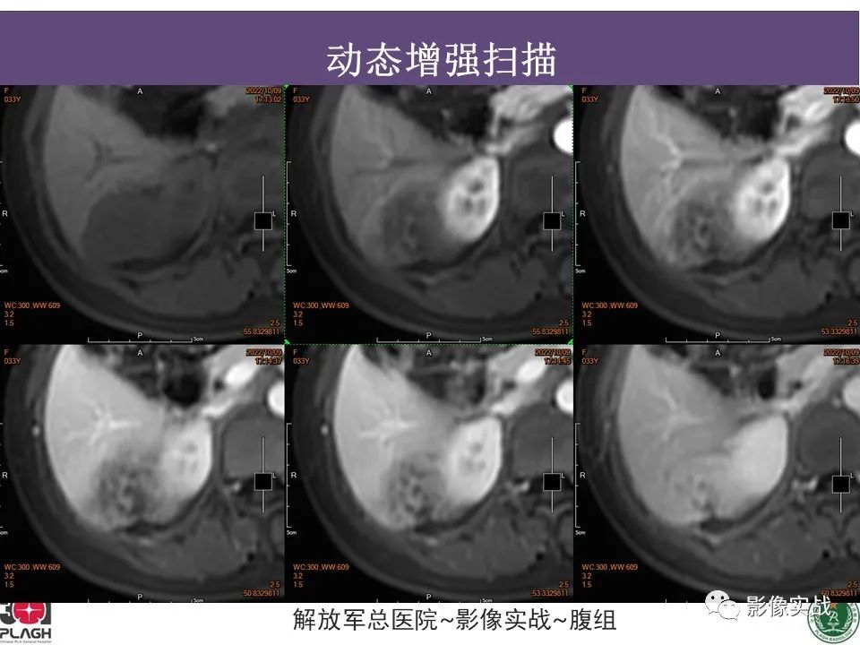 影像PPT - 【病例】肝内胆管细胞癌1例MR影像-17