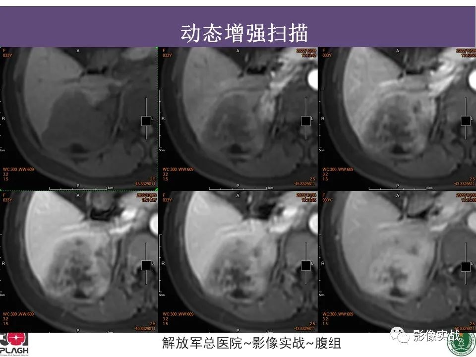 影像PPT - 【病例】肝内胆管细胞癌1例MR影像-16