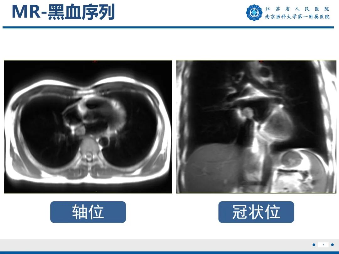 影像PPT - 【PPT】心脏黏液瘤—心脏肿瘤MR评估-5