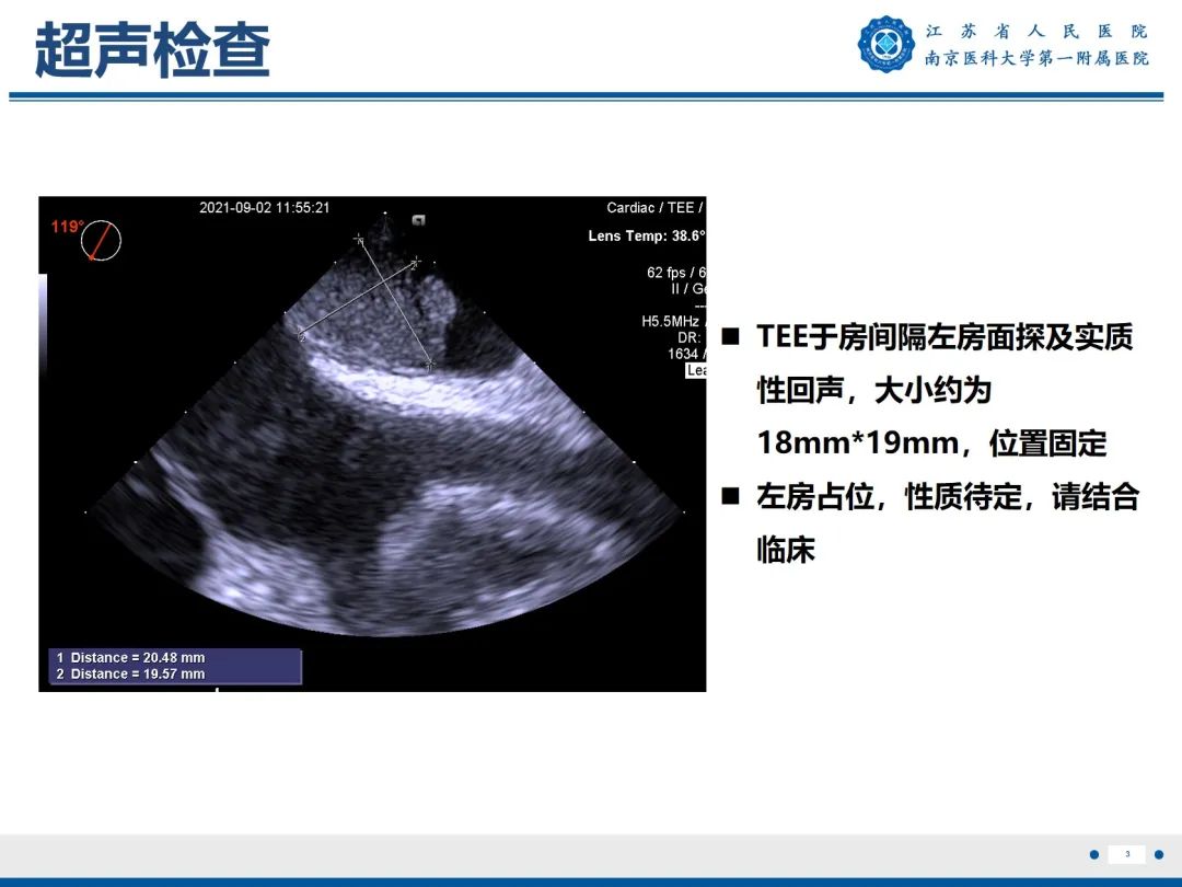影像PPT - 【PPT】心脏黏液瘤—心脏肿瘤MR评估-4