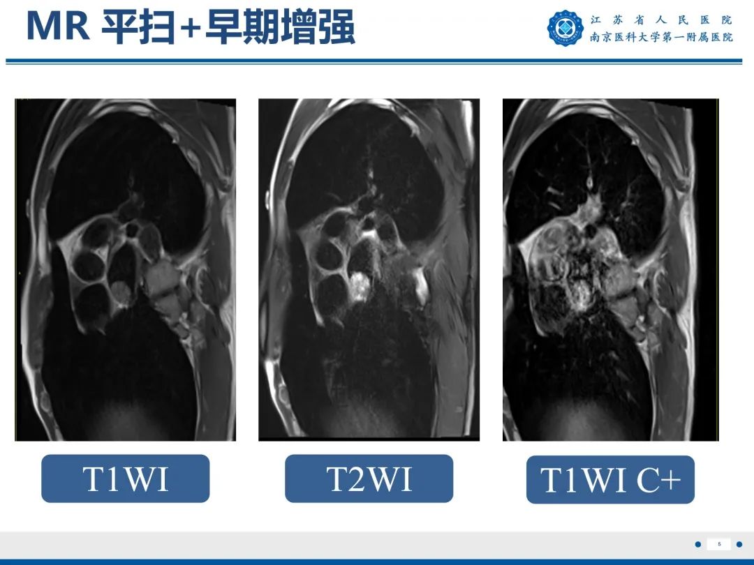 影像PPT - 【PPT】心脏黏液瘤—心脏肿瘤MR评估-6