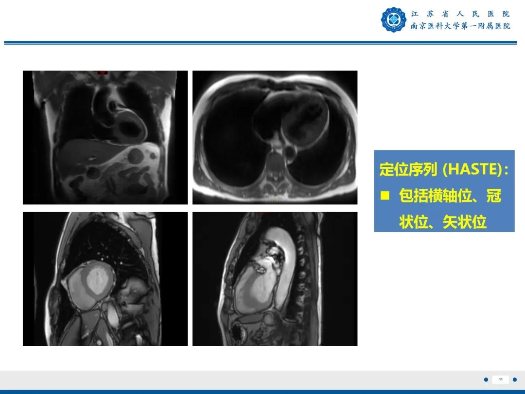 影像PPT - 【PPT】心脏黏液瘤—心脏肿瘤MR评估-12