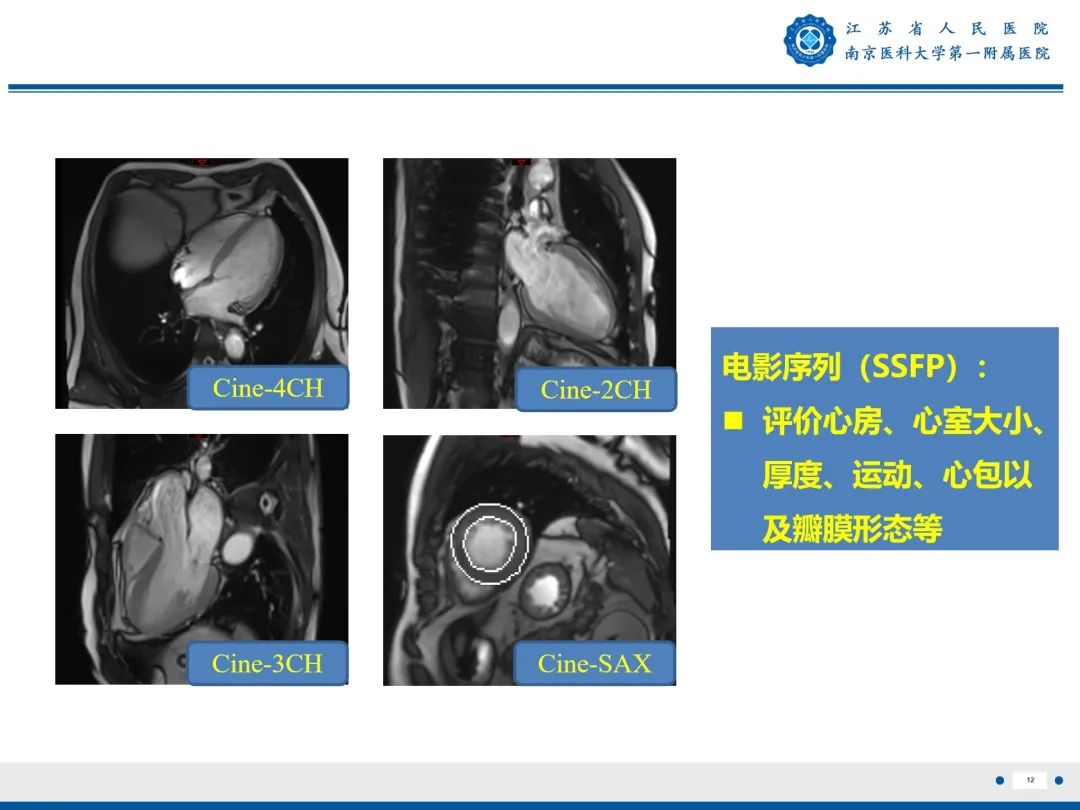 影像PPT - 【PPT】心脏黏液瘤—心脏肿瘤MR评估-13