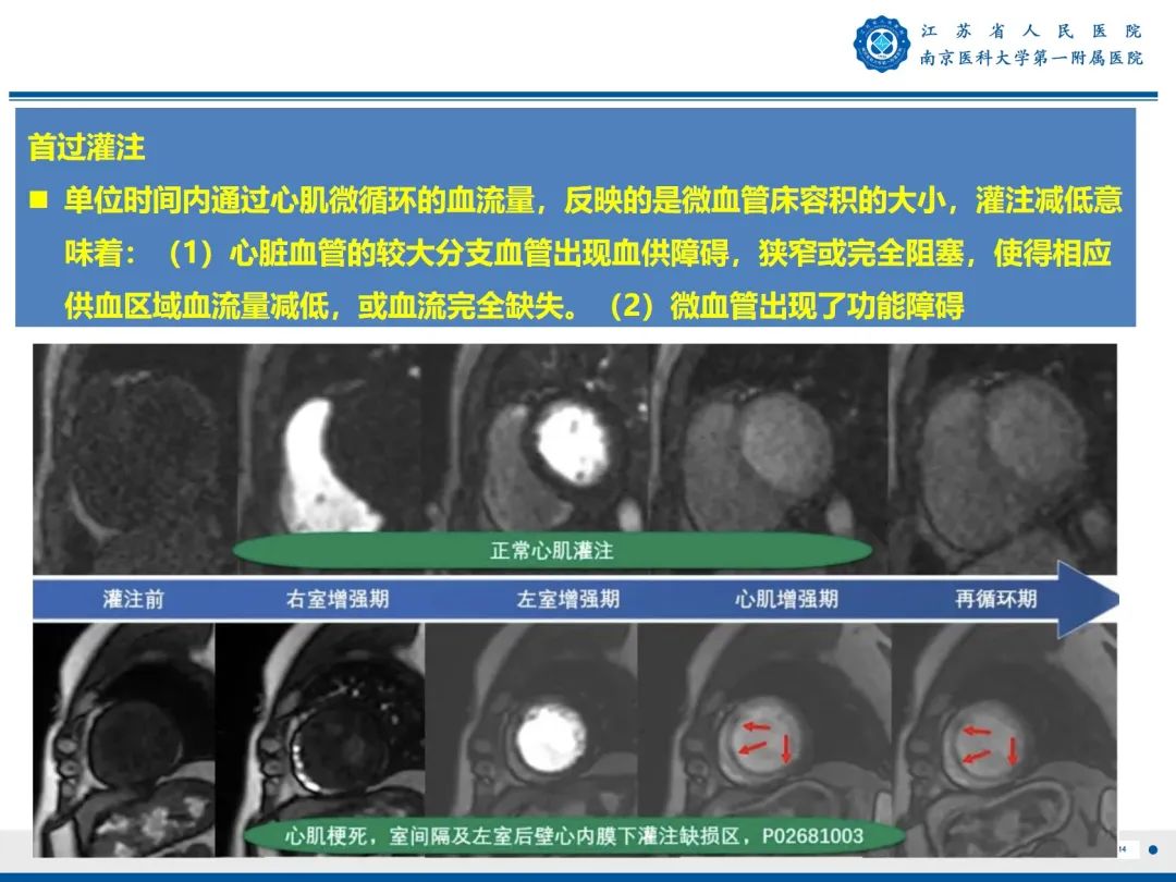 影像PPT - 【PPT】心脏黏液瘤—心脏肿瘤MR评估-15