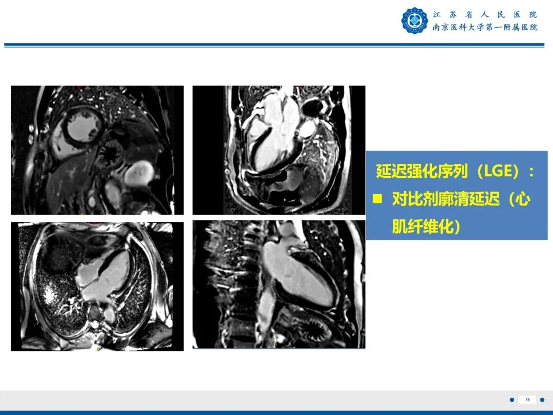 影像PPT - 【PPT】心脏黏液瘤—心脏肿瘤MR评估-16