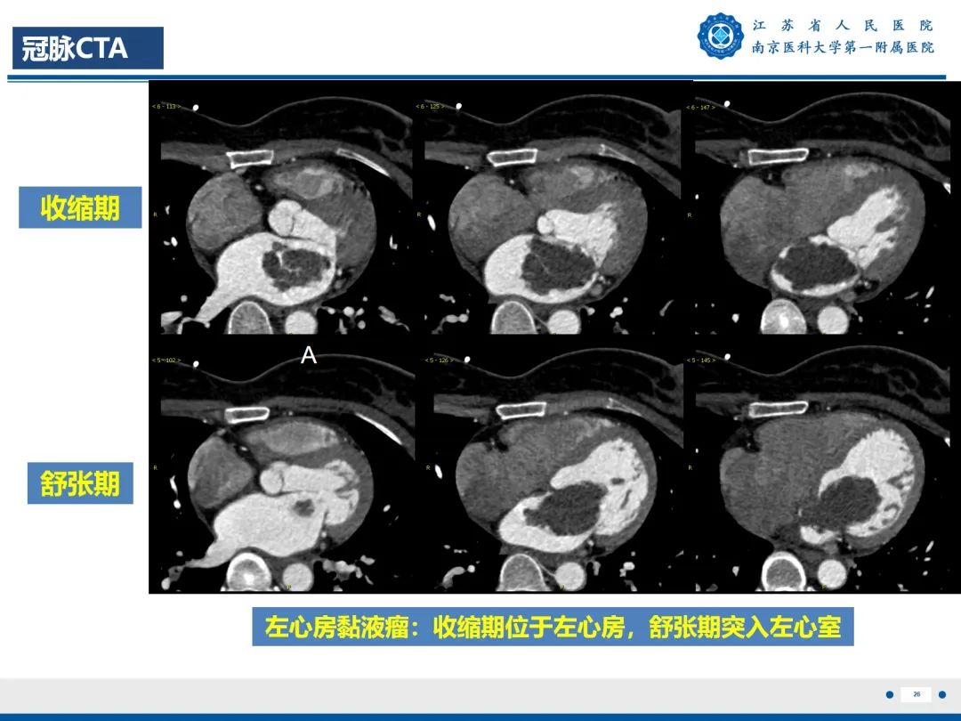 影像PPT - 【PPT】心脏黏液瘤—心脏肿瘤MR评估-27