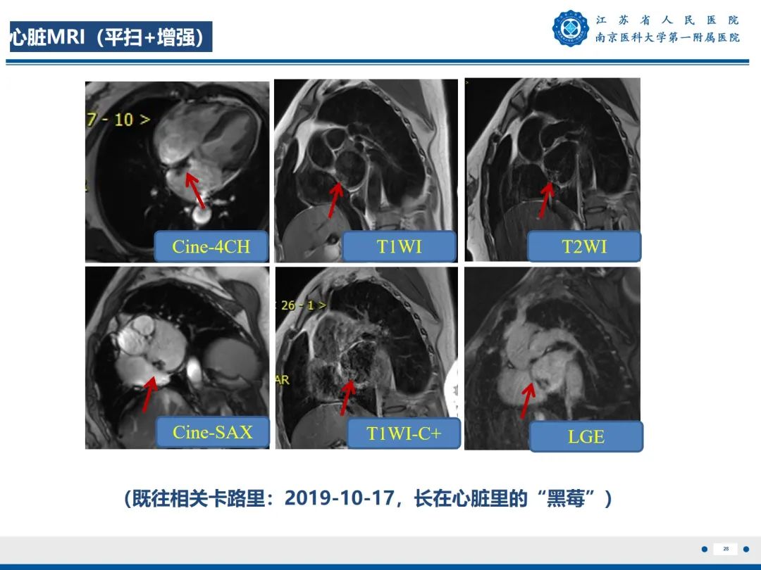 影像PPT - 【PPT】心脏黏液瘤—心脏肿瘤MR评估-29
