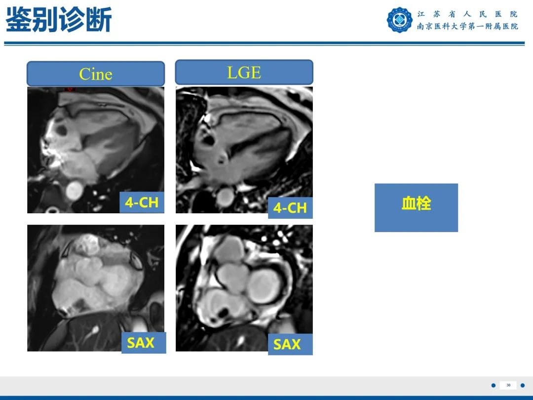 影像PPT - 【PPT】心脏黏液瘤—心脏肿瘤MR评估-31