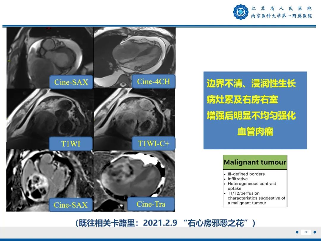 影像PPT - 【PPT】心脏黏液瘤—心脏肿瘤MR评估-41