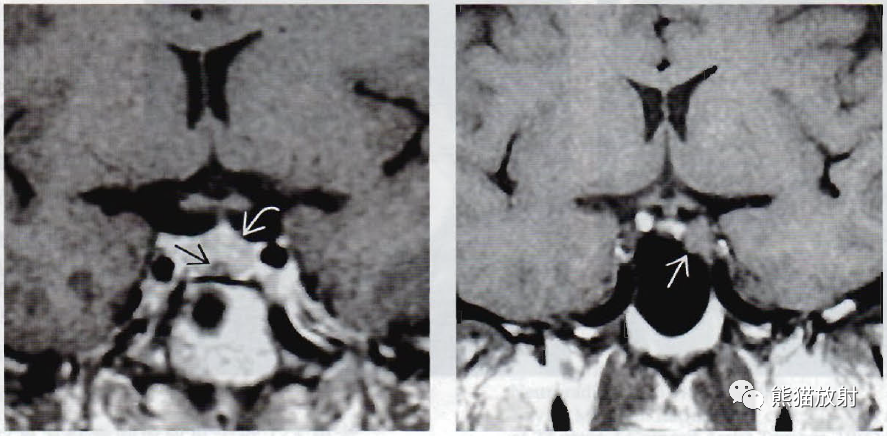 影像PPT - ​垂体微腺瘤、垂体大腺瘤影像诊断要点-2