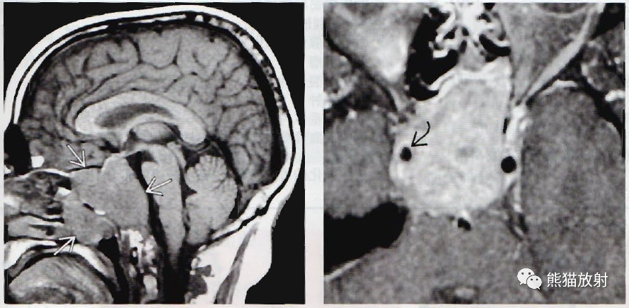 影像PPT - ​垂体微腺瘤、垂体大腺瘤影像诊断要点-7