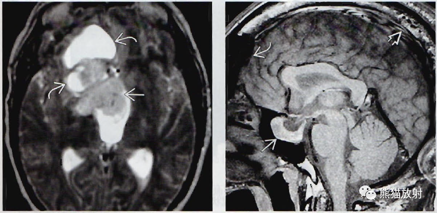 影像PPT - ​垂体微腺瘤、垂体大腺瘤影像诊断要点-9