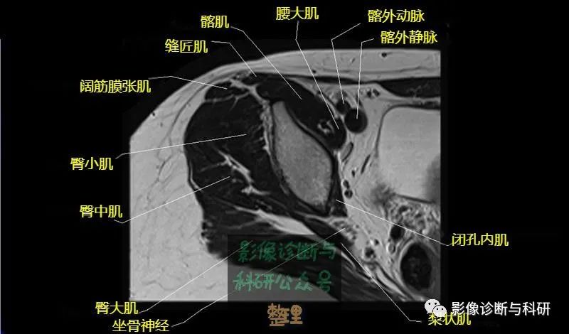 影像PPT - 髋关节MR轴位详细标注-5 影像PPT - 髋关节MR轴位详细标注-5