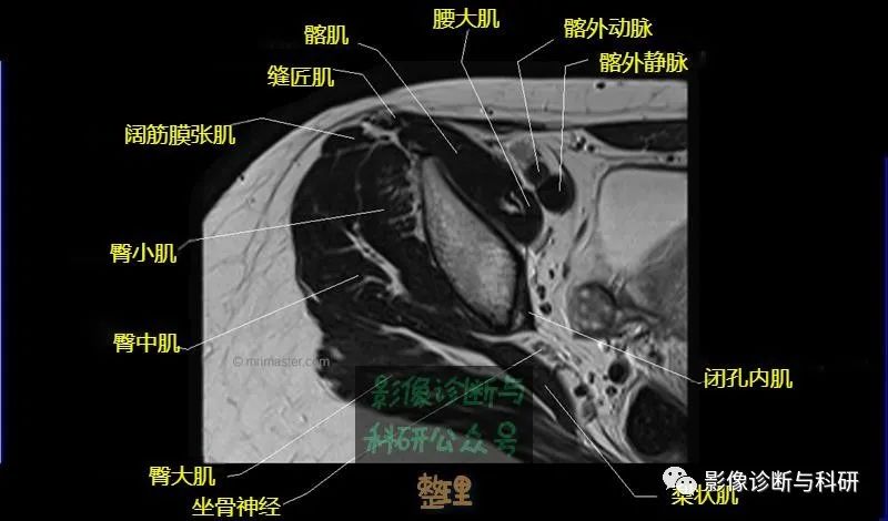 影像PPT - 髋关节MR轴位详细标注-4 影像PPT - 髋关节MR轴位详细标注-4