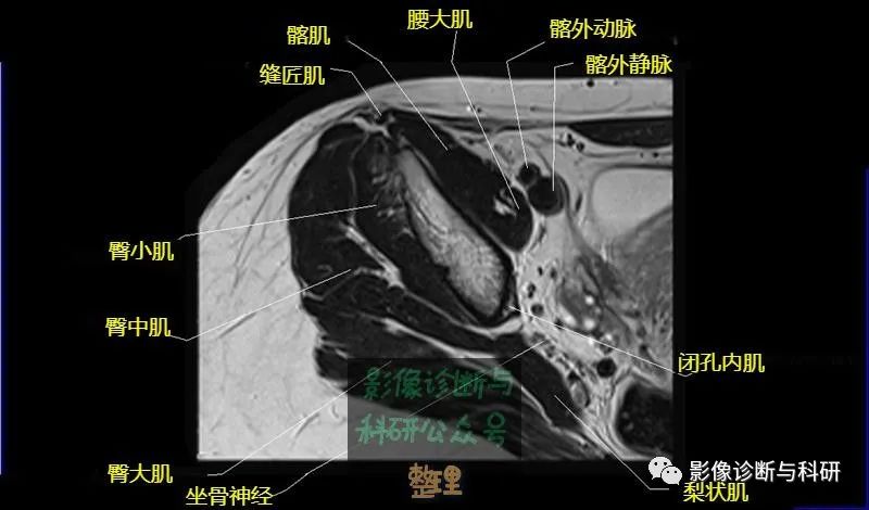 影像PPT - 髋关节MR轴位详细标注-3 影像PPT - 髋关节MR轴位详细标注-3
