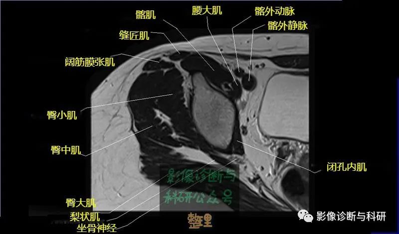 影像PPT - 髋关节MR轴位详细标注-6 影像PPT - 髋关节MR轴位详细标注-6