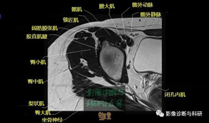 影像PPT - 髋关节MR轴位详细标注-7 影像PPT - 髋关节MR轴位详细标注-7