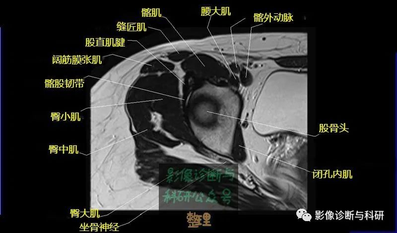 影像PPT - 髋关节MR轴位详细标注-8 影像PPT - 髋关节MR轴位详细标注-8