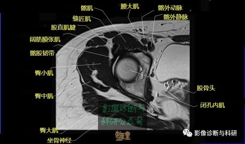 影像PPT - 髋关节MR轴位详细标注-9 影像PPT - 髋关节MR轴位详细标注-9