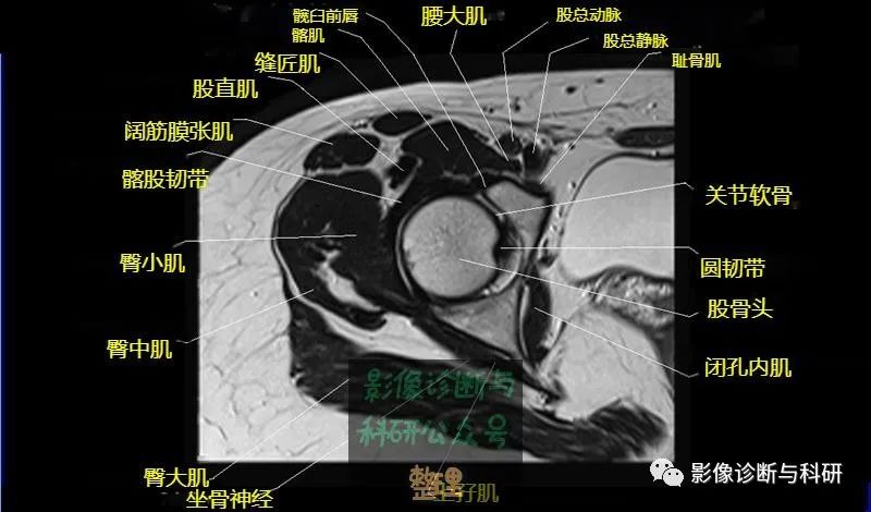 影像PPT - 髋关节MR轴位详细标注-10 影像PPT - 髋关节MR轴位详细标注-10