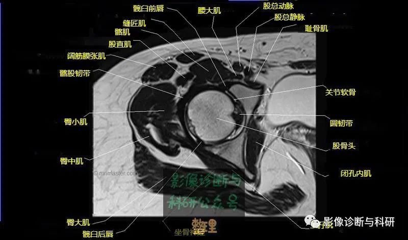 影像PPT - 髋关节MR轴位详细标注-11 影像PPT - 髋关节MR轴位详细标注-11