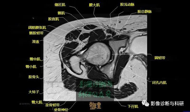 影像PPT - 髋关节MR轴位详细标注-13 影像PPT - 髋关节MR轴位详细标注-13