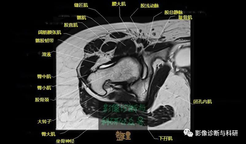 影像PPT - 髋关节MR轴位详细标注-14 影像PPT - 髋关节MR轴位详细标注-14