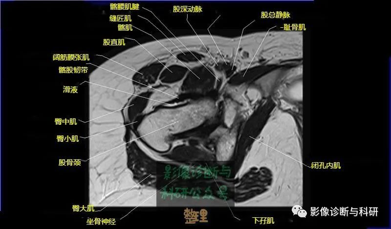 影像PPT - 髋关节MR轴位详细标注-15 影像PPT - 髋关节MR轴位详细标注-15