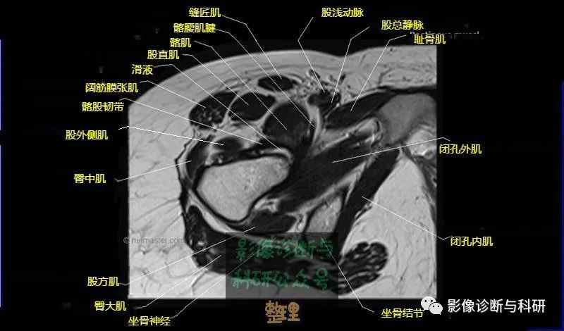 影像PPT - 髋关节MR轴位详细标注-16 影像PPT - 髋关节MR轴位详细标注-16