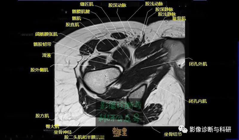 影像PPT - 髋关节MR轴位详细标注-17 影像PPT - 髋关节MR轴位详细标注-17