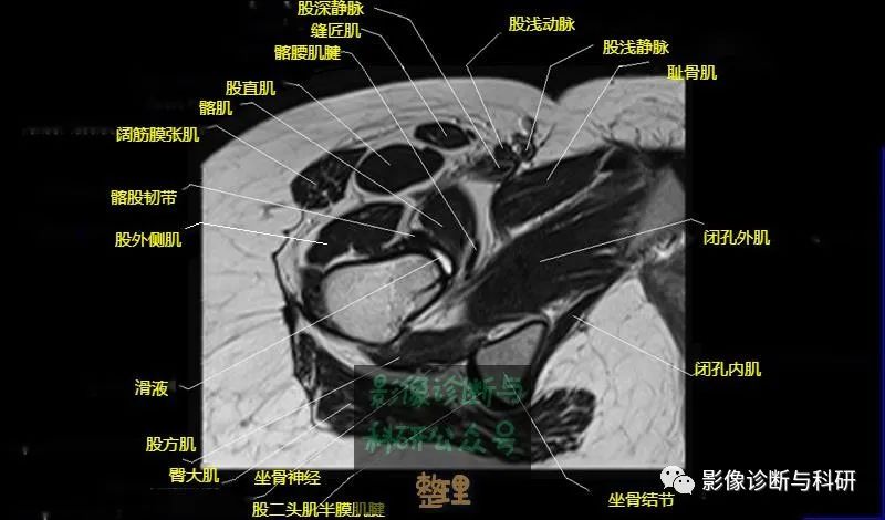 影像PPT - 髋关节MR轴位详细标注-18 影像PPT - 髋关节MR轴位详细标注-18
