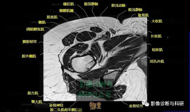 影像PPT - 髋关节MR轴位详细标注-19 影像PPT - 髋关节MR轴位详细标注-19