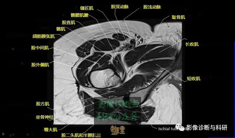 影像PPT - 髋关节MR轴位详细标注-20 影像PPT - 髋关节MR轴位详细标注-20
