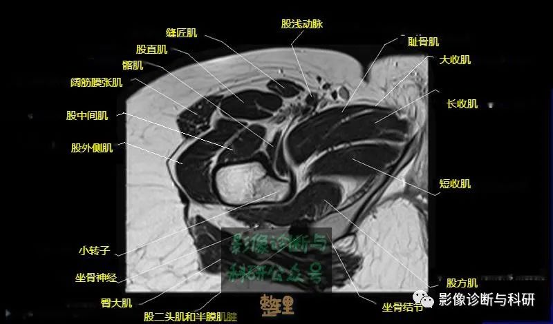 影像PPT - 髋关节MR轴位详细标注-21 影像PPT - 髋关节MR轴位详细标注-21