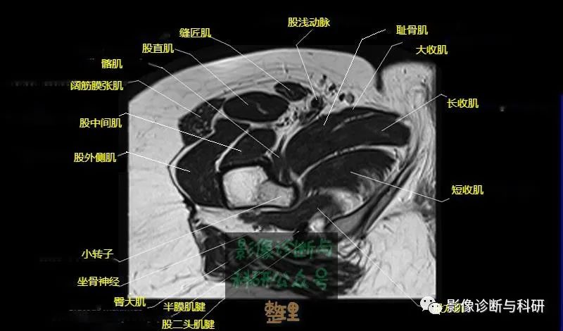 影像PPT - 髋关节MR轴位详细标注-22 影像PPT - 髋关节MR轴位详细标注-22