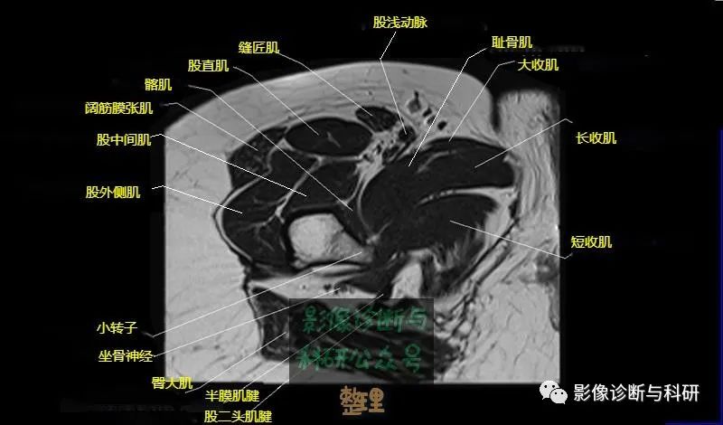 影像PPT - 髋关节MR轴位详细标注-23 影像PPT - 髋关节MR轴位详细标注-23