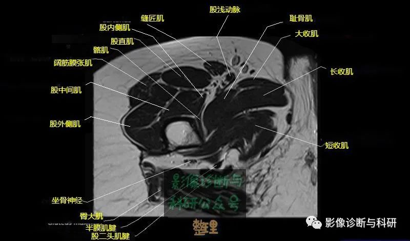 影像PPT - 髋关节MR轴位详细标注-24 影像PPT - 髋关节MR轴位详细标注-24