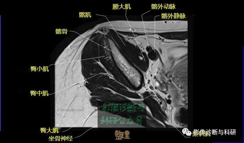 影像PPT - 髋关节MR轴位详细标注-1 影像PPT - 髋关节MR轴位详细标注-1