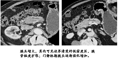 影像PPT - 自身免疫性胰腺炎的影像学表现-4 影像PPT - 自身免疫性胰腺炎的影像学表现-4