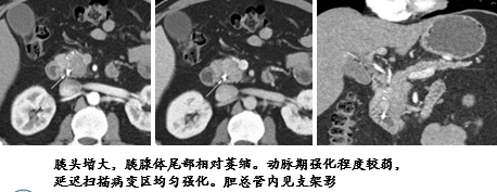 影像PPT - 自身免疫性胰腺炎的影像学表现-3 影像PPT - 自身免疫性胰腺炎的影像学表现-3