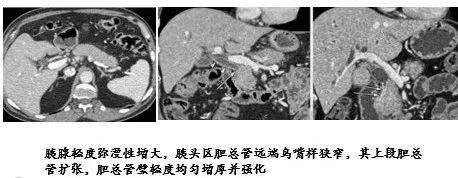 影像PPT - 自身免疫性胰腺炎的影像学表现-6 影像PPT - 自身免疫性胰腺炎的影像学表现-6