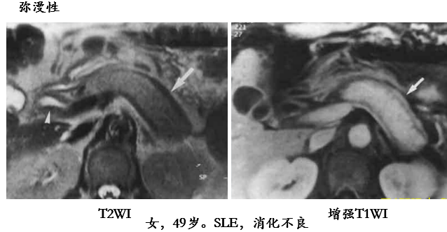 影像PPT - 自身免疫性胰腺炎的影像学表现-8 影像PPT - 自身免疫性胰腺炎的影像学表现-8