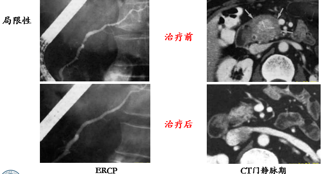 影像PPT - 自身免疫性胰腺炎的影像学表现-9 影像PPT - 自身免疫性胰腺炎的影像学表现-9