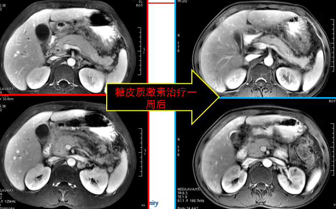 影像PPT - 自身免疫性胰腺炎的影像学表现-10 影像PPT - 自身免疫性胰腺炎的影像学表现-10