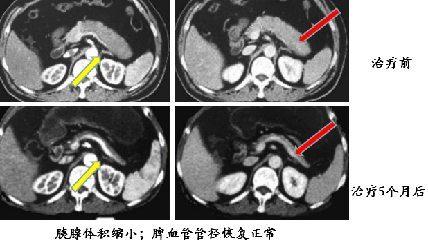 影像PPT - 自身免疫性胰腺炎的影像学表现-11 影像PPT - 自身免疫性胰腺炎的影像学表现-11