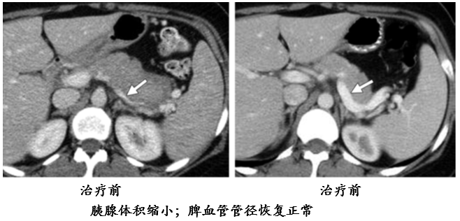 影像PPT - 自身免疫性胰腺炎的影像学表现-12 影像PPT - 自身免疫性胰腺炎的影像学表现-12