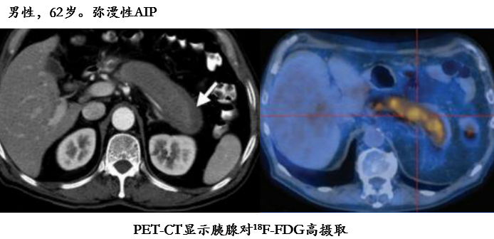 影像PPT - 自身免疫性胰腺炎的影像学表现-13 影像PPT - 自身免疫性胰腺炎的影像学表现-13