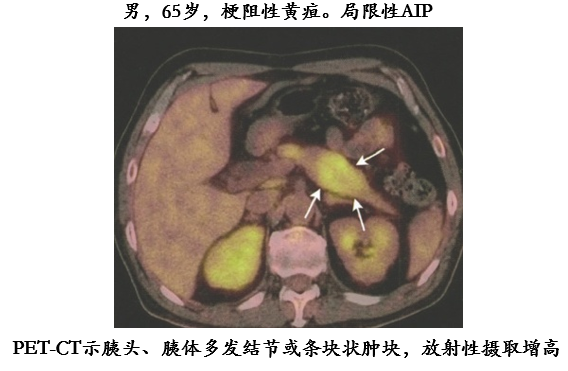 影像PPT - 自身免疫性胰腺炎的影像学表现-14 影像PPT - 自身免疫性胰腺炎的影像学表现-14